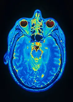 Normal Brain Structure Prints: MRI of Brain