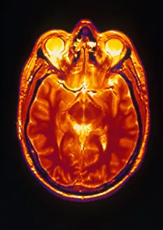 Normal Brain Structure Prints: MRI of Brain