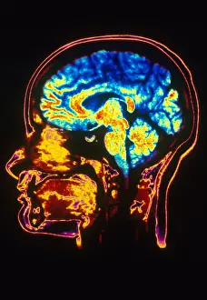 Normal Brain Structure Prints: MRI of Head
