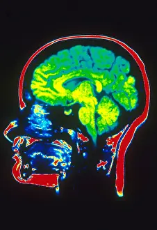 Normal Brain Structure Prints: MRI of Head