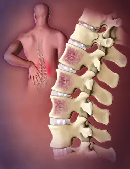 Osteoporosis Symptoms Prints: Multiple Myeloma