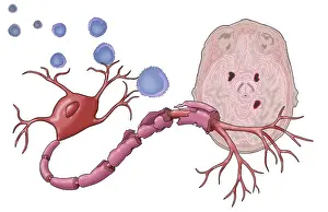 Framed Print : Multiple Sclerosis Print - Demyelinated Nerve Cells Framed Print : Multiple Sclerosis Print - Demyelinated Nerve Cells