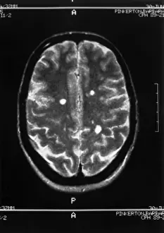 Multiple sclerosis MRI Print