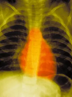 Human Respiratory System Anatomy Prints: Normal chest x-ray