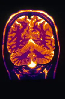 Normal Brain Anatomy Prints: Normal MRI of Brain