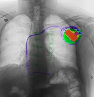 Human Anatomy Prints: Pacemaker